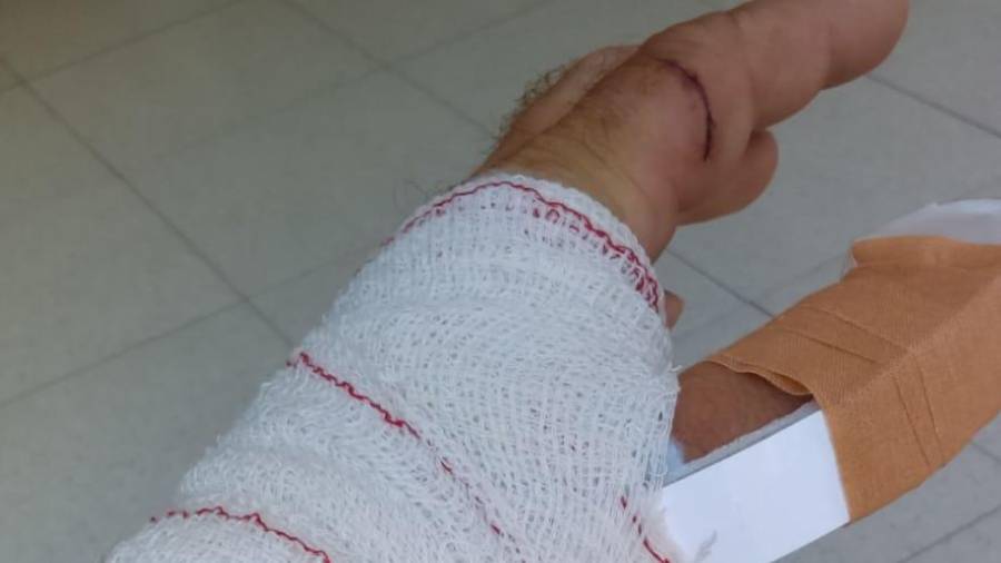 La mano del hombre vendada tras ser curado de las heridas provocadas por el perro. FOTO: DT