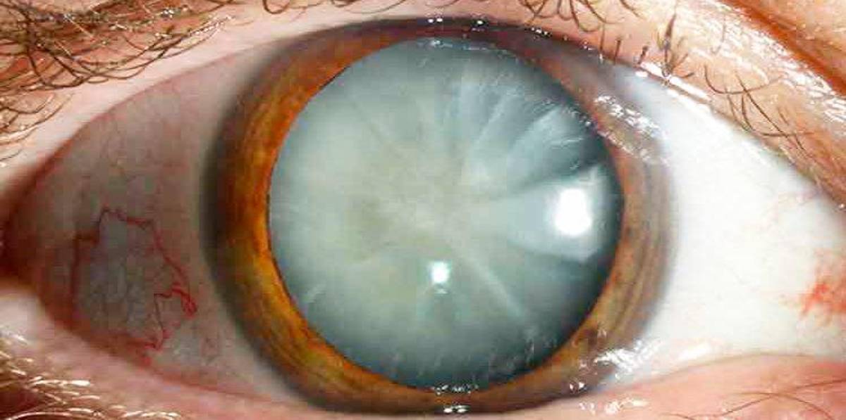 Un ojo afectado por catarata.