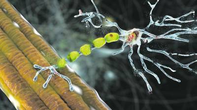 Ilustración conceptual de la degradación de las neuronas motoras, algo provocado por la ELA. Foto: Getty Images