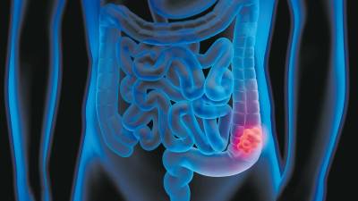 El año pasado se diagnosticaron en España más de 43.000 nuevos casos de cáncer de colon. Foto: Getty Images