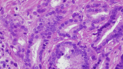 imatge histològica d'un adenocarcinoma prostàtic