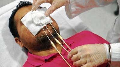 Simulació de l’aplicació del tractament de càncer de pell sobre un pacient amb la màscara feta amb la impressora 3D. FOTO: urv