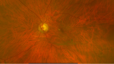 Imagen muestra perdida de fibras del nervio óptico provocado por el glaucoma.