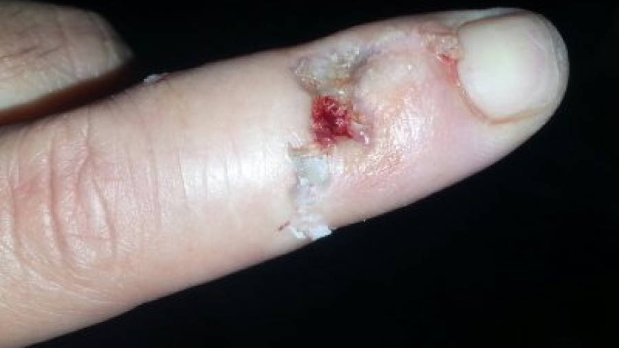 Aspecte de la ferida que l'acusat va provocar, amb una mossegada, al dit d'un mosso d'esquadra. Foto: ACN