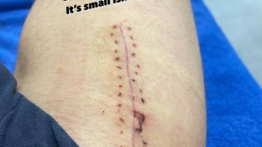 Sergi Roberto enseña su cicatriz en Instagram: Foto: Instagram