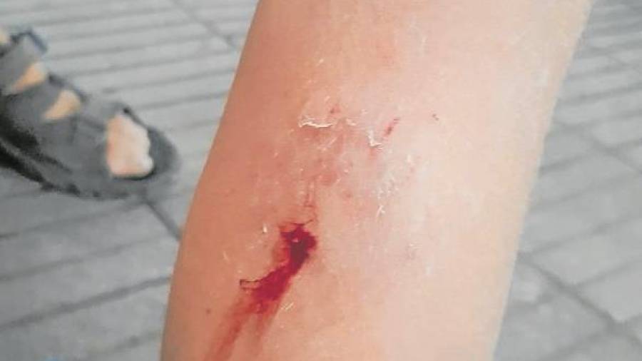 Mordedura en la pierna de una niña de 5 años. FOTO: Cedida