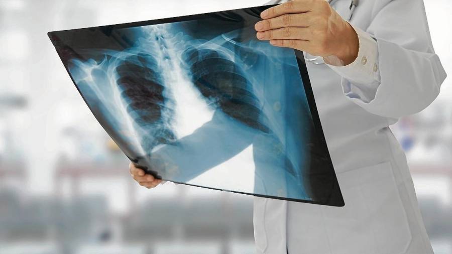 Los médicos insisten en que el cáncer de pulmón se debe principalmente al tabaco. FOTO: THINKSTOCKPHOTOS