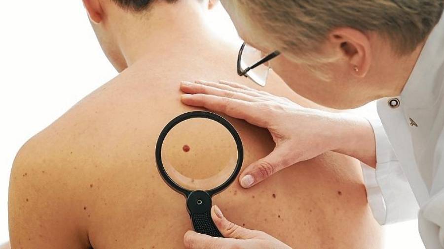 El melanoma es el cáncer de piel más prevenible y con buen pronóstico si se detecta a tiempo. FOTO: Getty Images
