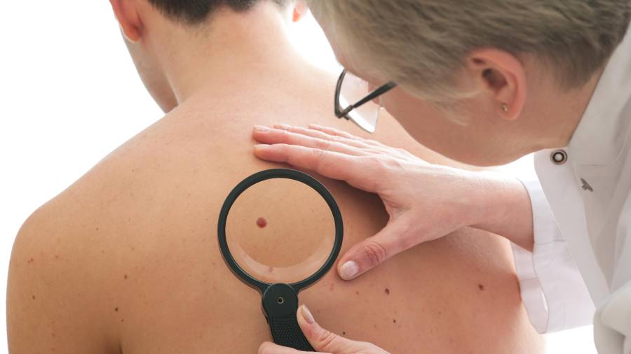 El melanoma es la forma más mortal de cáncer de piel. FOTO: GETTY IMAGES