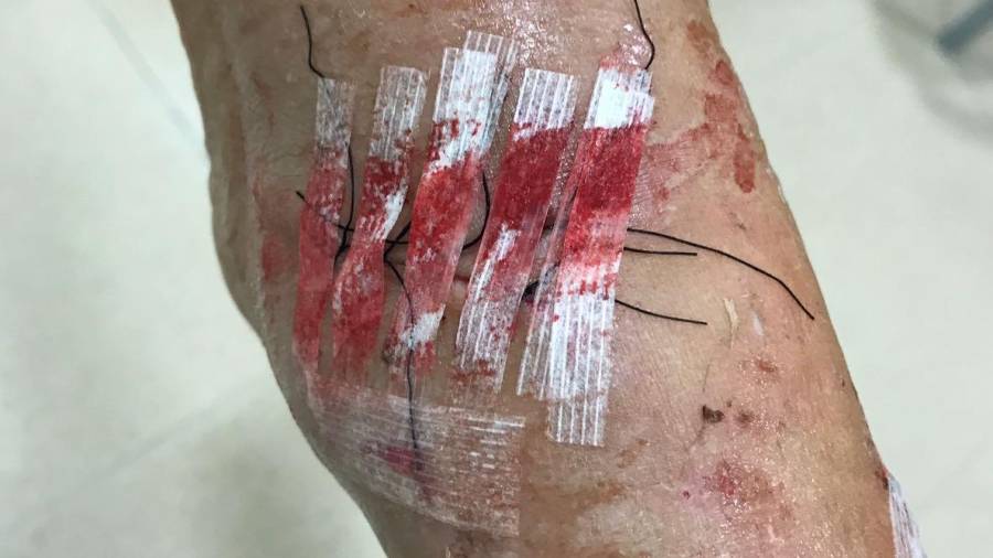 Las heridas que sufrió la mujer tras defenderse del Pit bull. FOTO: DT